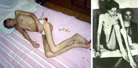 Затворници в китайски лагери. На снимката вляво: Ан Сенбяо, практикуващ Фалун Гонг, след затварянето му в лагера. На снимката вдясно: затворници в нацисткия лагер Аушвиц.